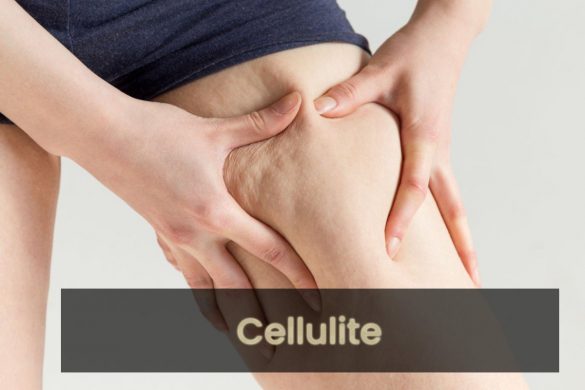 Cellulite